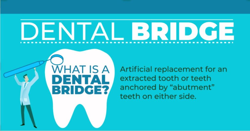 Dental Bridges