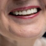 Does Insurance Cover Veneers