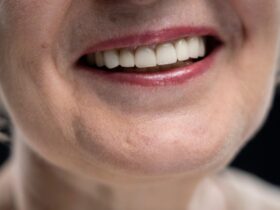 Does Insurance Cover Veneers