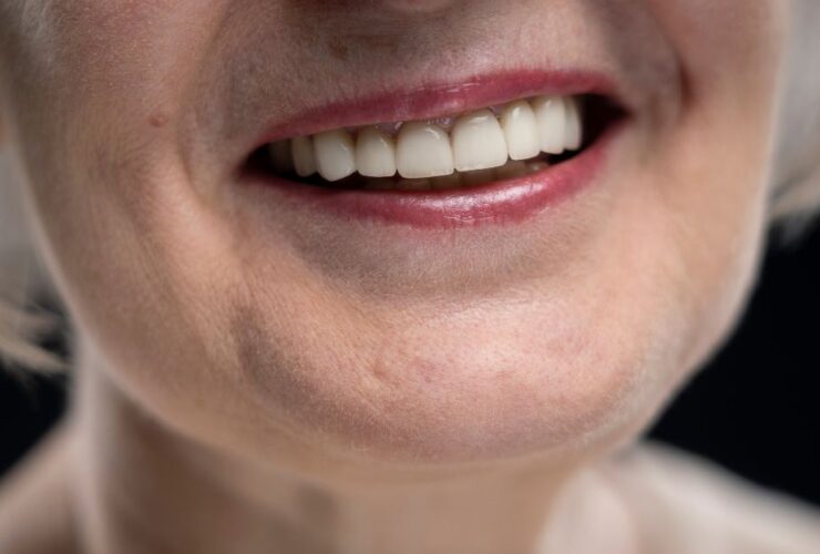 Does Insurance Cover Veneers