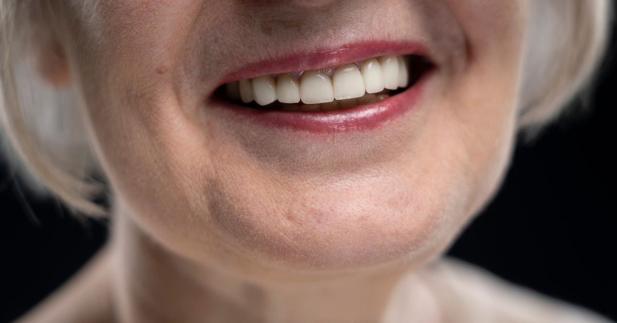 Does Insurance Cover Veneers